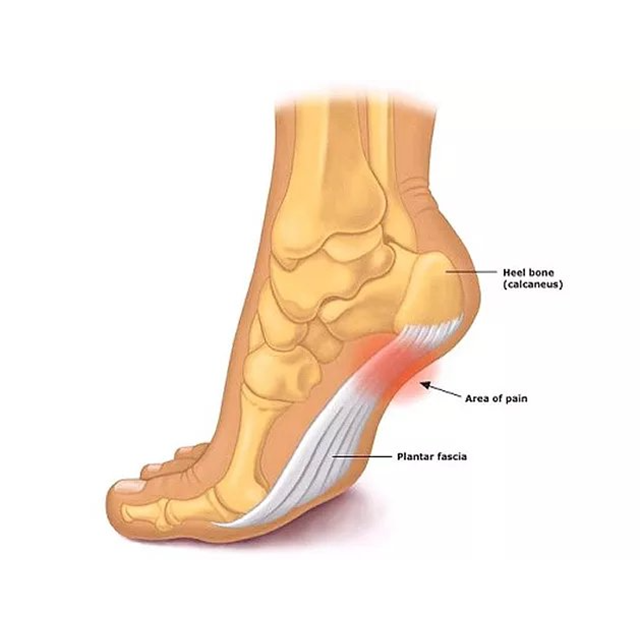 Top 10 Plantar Fasciitis Treatments For Lasting Relief