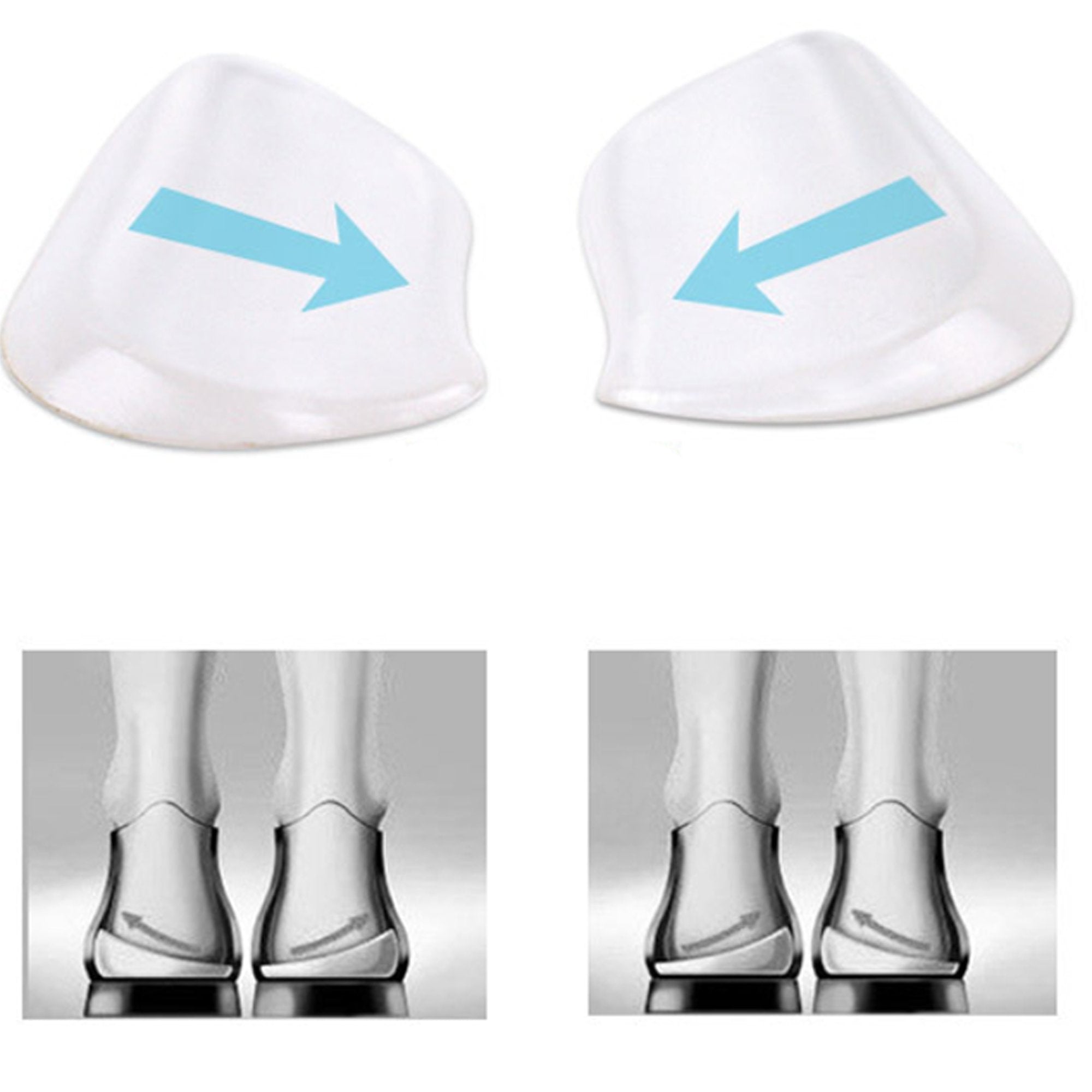 Mars Wellness Medial & Lateral Heel Wedge Silicone 2 Pairs - Universal - Adhesive Shoe Insert for Knock Knee Pain, Bow Legs, Foot Alignment - Pronation, Supination