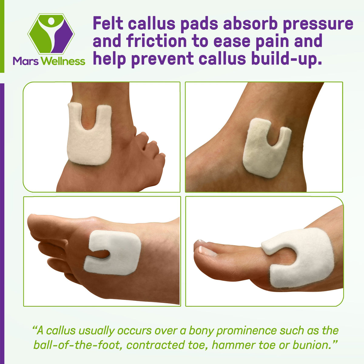 U Shaped Felt Callus Pads - Adhesive Foot Pads That Protect Calluses from Rubbing On Shoes - 3/16"