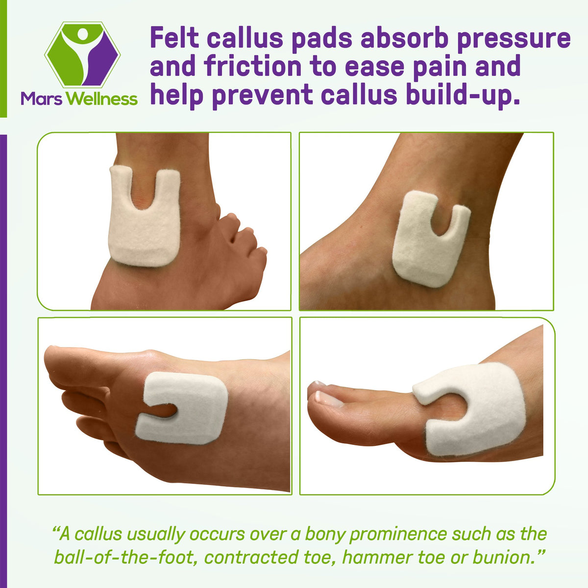 U Shaped Felt Callus Pads - Adhesive Foot Pads That Protect Calluses from Rubbing On Shoes - Skived 1/4"